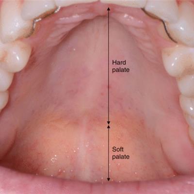 Palate
